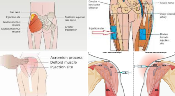 ⁠Intramuscular Injection Techniques